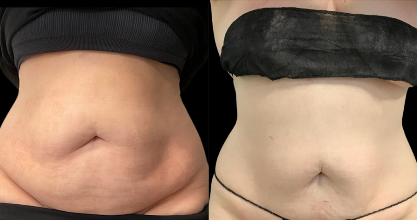 niwabeforeafter3